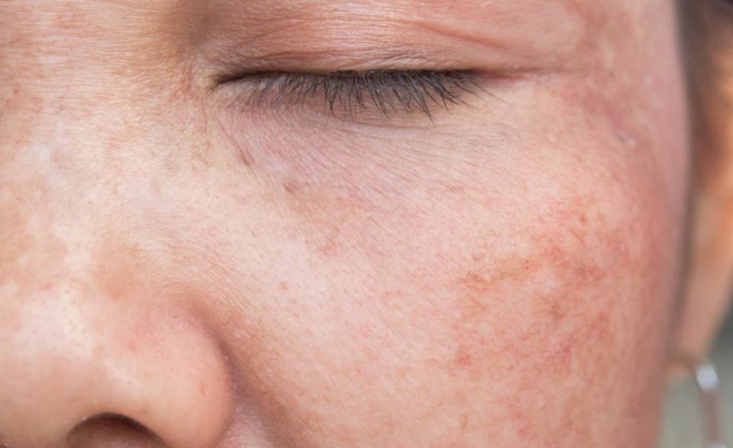 tratamiento manchas en la piel